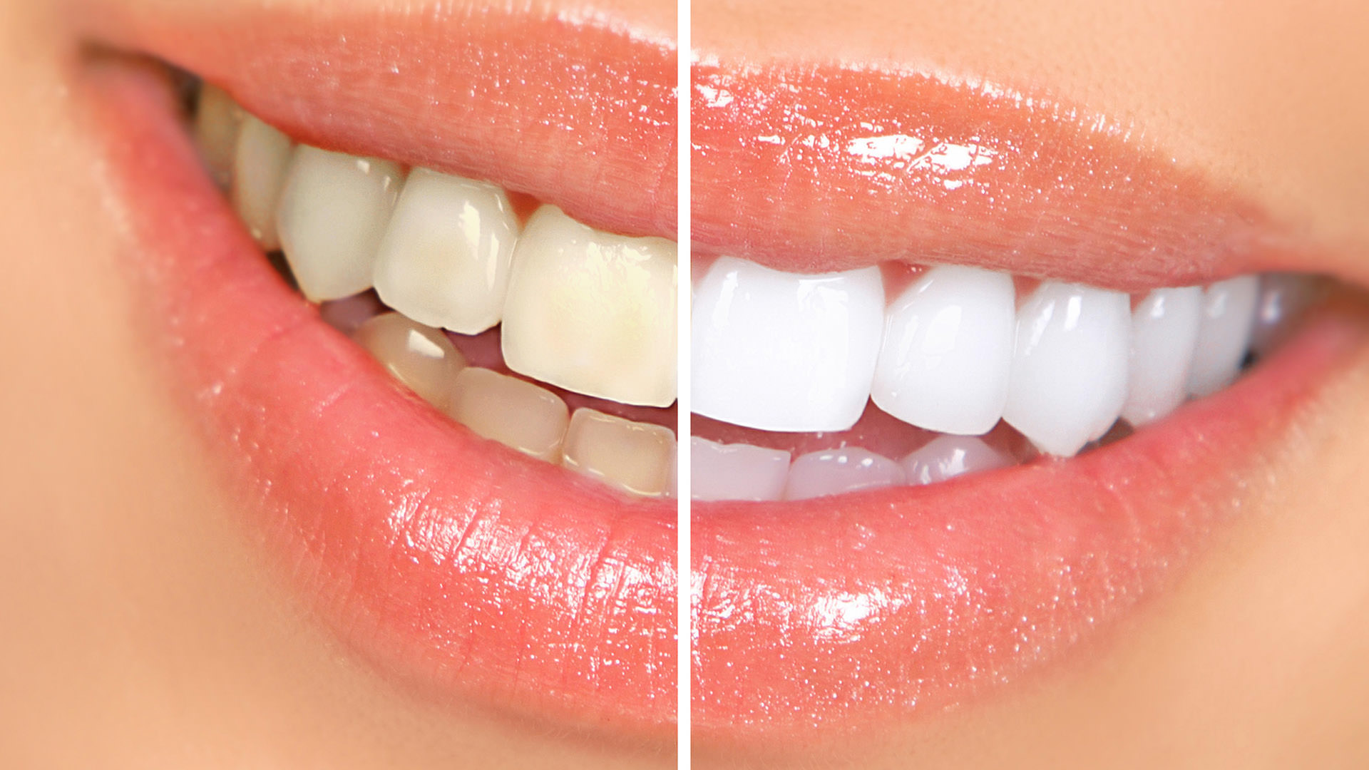 Smile confidently with a *free* teeth whitening makeover from Church Road Dental